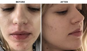 Periorbital dermatitis natural treatment before and after — reduced inflammation, redness and bumps after healing