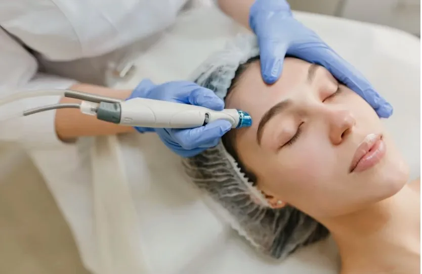 Morpheus8 RF microneedling treatment on a woman's face