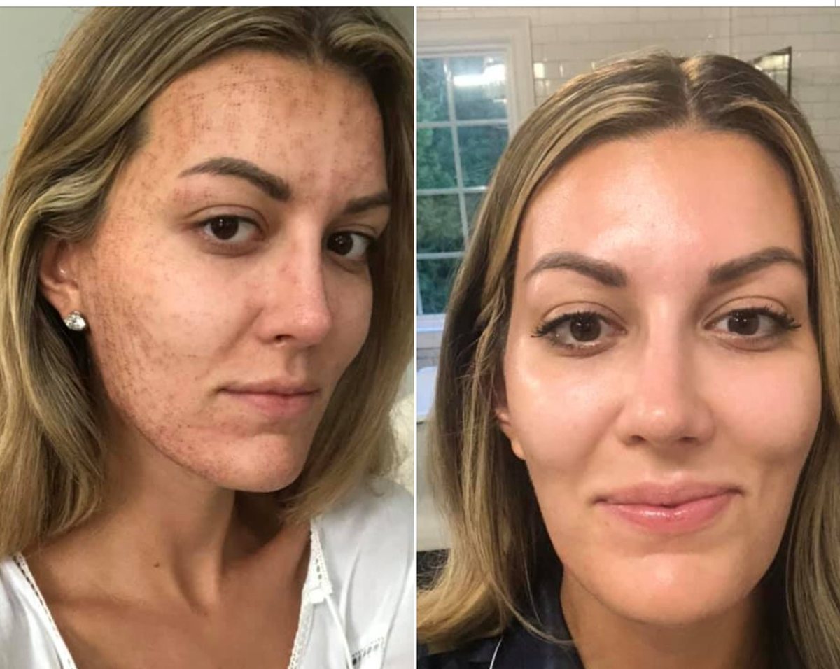 Before and after photos of a woman's face showing skin damage from microneedling on the left and clear, healed skin on the right