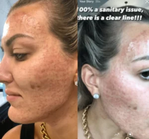 Close-up of a woman's cheek showing redness and track marks after a microneedling treatment gone wrong