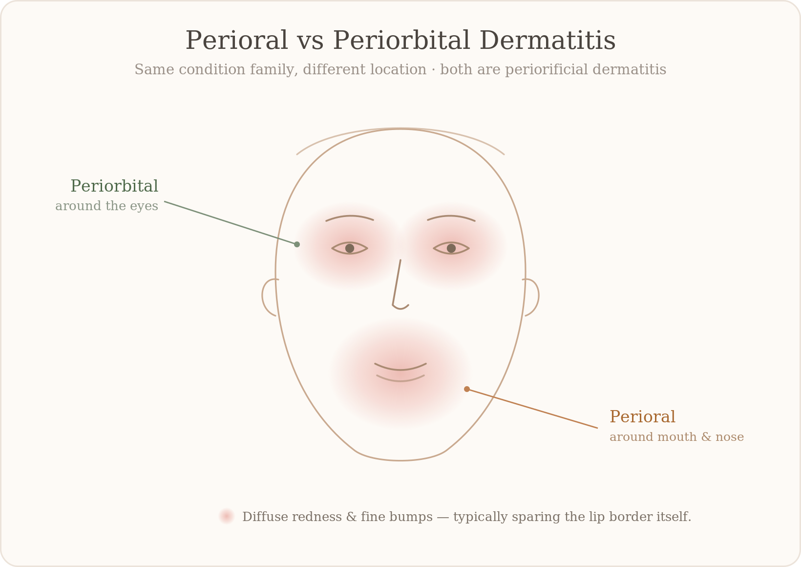 Where each appears: periorbital around the eyes, perioral around the mouth and nose — both forms of periorificial dermatitis.